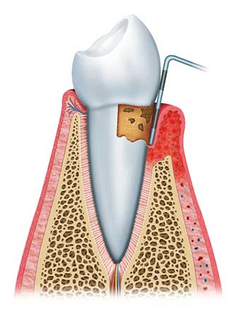 Zahnfleischreinigung